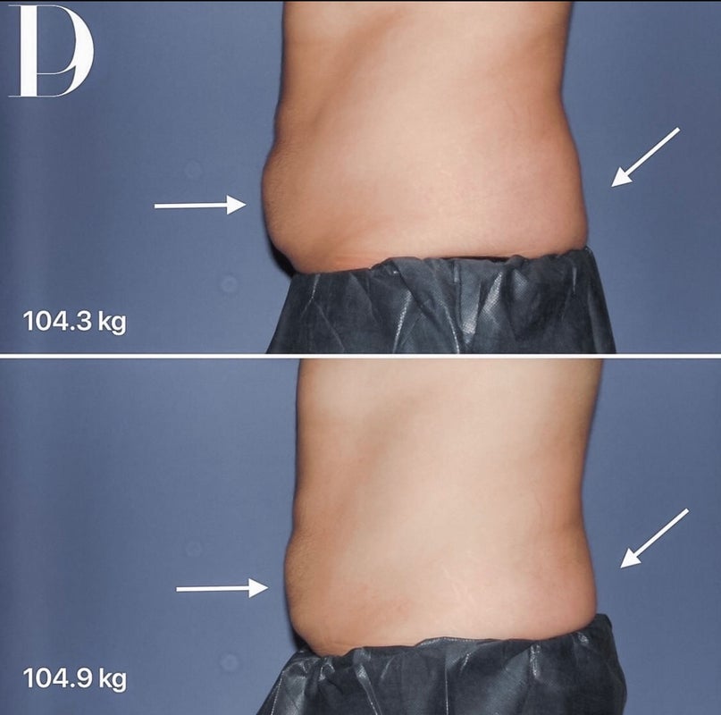 How Long Do Body Contouring Results Last? Pacific Derm Answers Your  Questions - Pacific Derm
