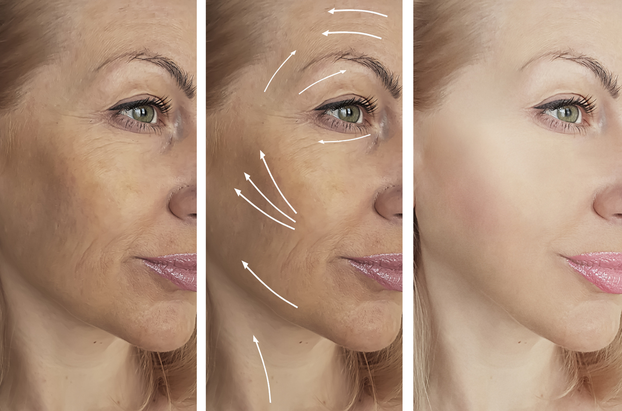 Learning The Difference Between Skin Tightening and Soft Lift: Rejuvenate  with Pacific Derm - Pacific Derm